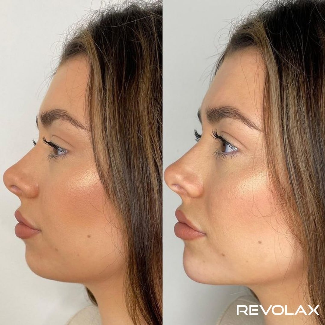 REVOLAX before and after