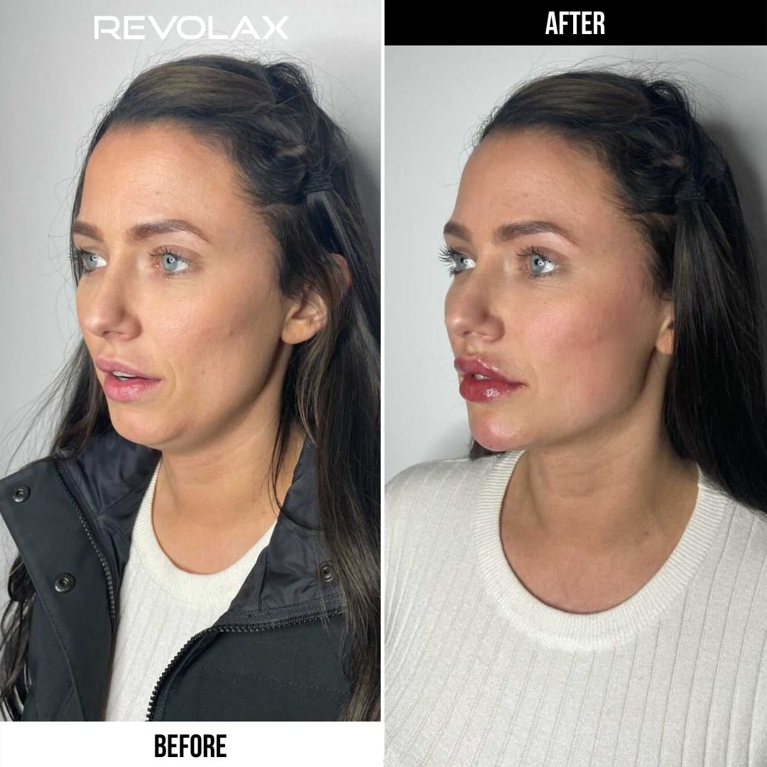 REVOLAX before and after